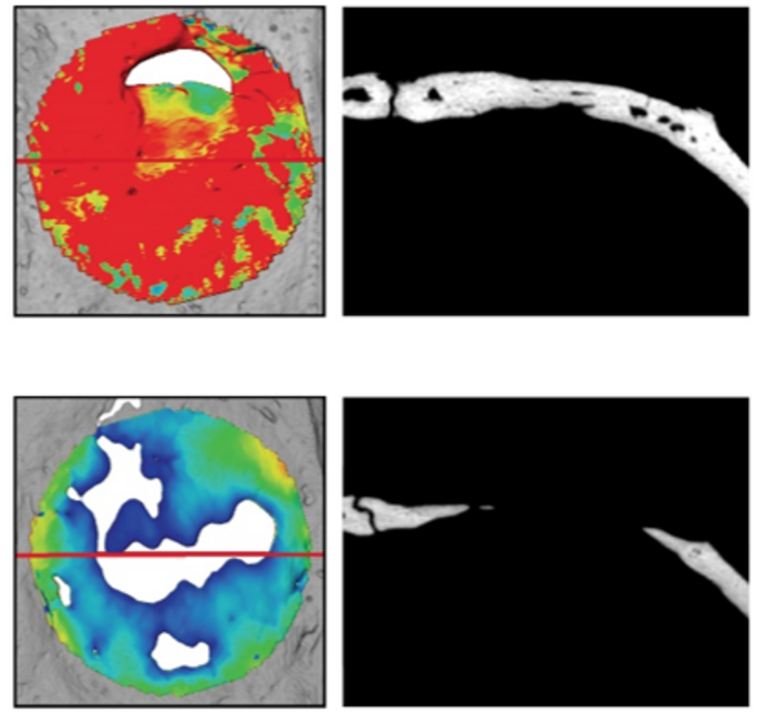 Micro-CT reconstructions of a bone defect that has been filled with new bone following the hydrogel implantation.