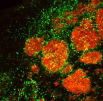 Therapeutic Stem Cells Target Breast-To-Brain Metastases