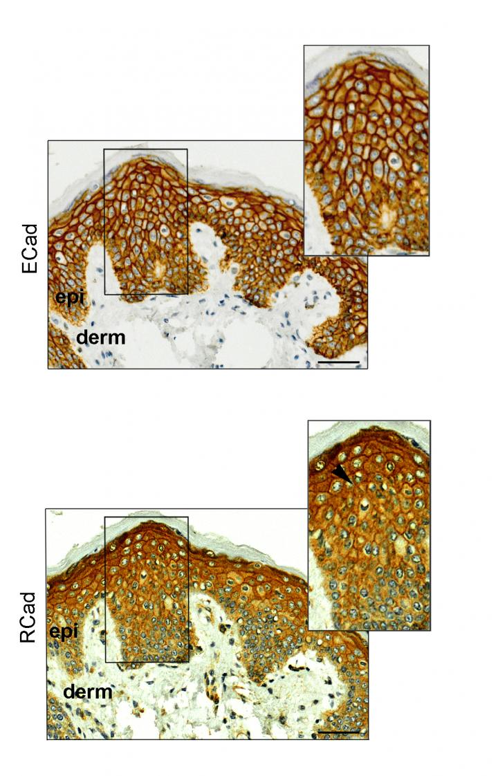 E-Caderina and R-Caderina in Breast Cancer