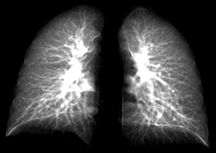 Long-COVID lungs