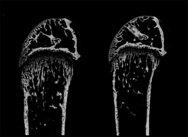 Reversing Severe Bone Loss