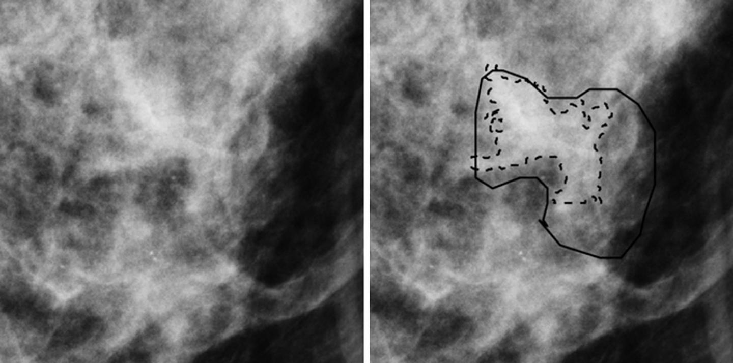 Novel Technique May Significantly Reduce Breast Biopsies 2