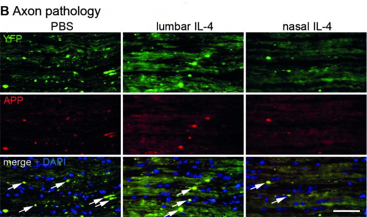 Inhaled Treatment Prevents Neuron Destruction in Mouse Models of Neuroinflammatory Disease