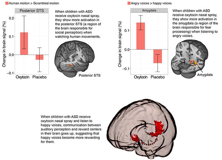 Change in Brain Signal When Children with ASD Receive Oxytocin Nasal Spray