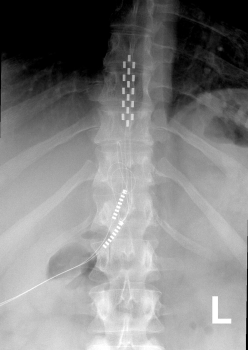X-ray of a human spinal column with spinal cord stimulator implant