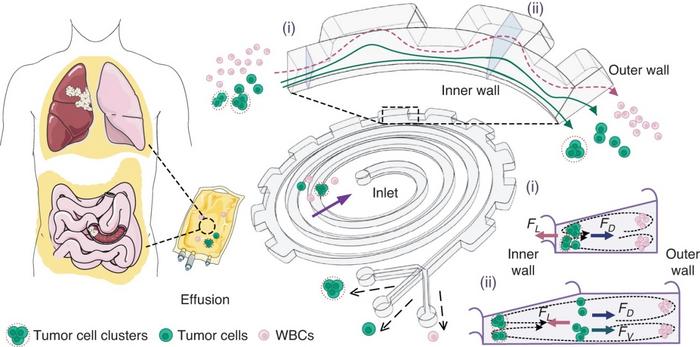 Schematic illustration of high-throughput, continuous-flow ternary separation of tumor cells and clusters from WBCs in large volumes of pleural or abdominal effusions using our spiral-contraction-expansion device.