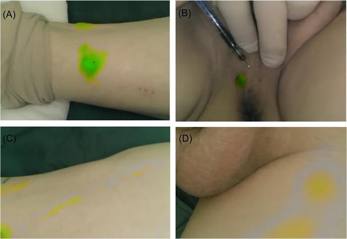 Fluorescent imaging of indocyanine green (ICG) injection site and its flow in lower limb lymph nodes.