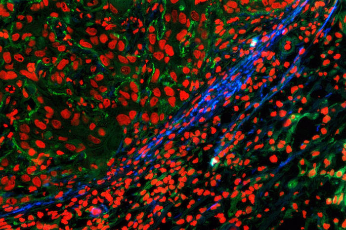 Tumour boundary