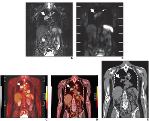 68-Year-Old Woman With Pathologically Diagnosed Small Cell Lung Cancer