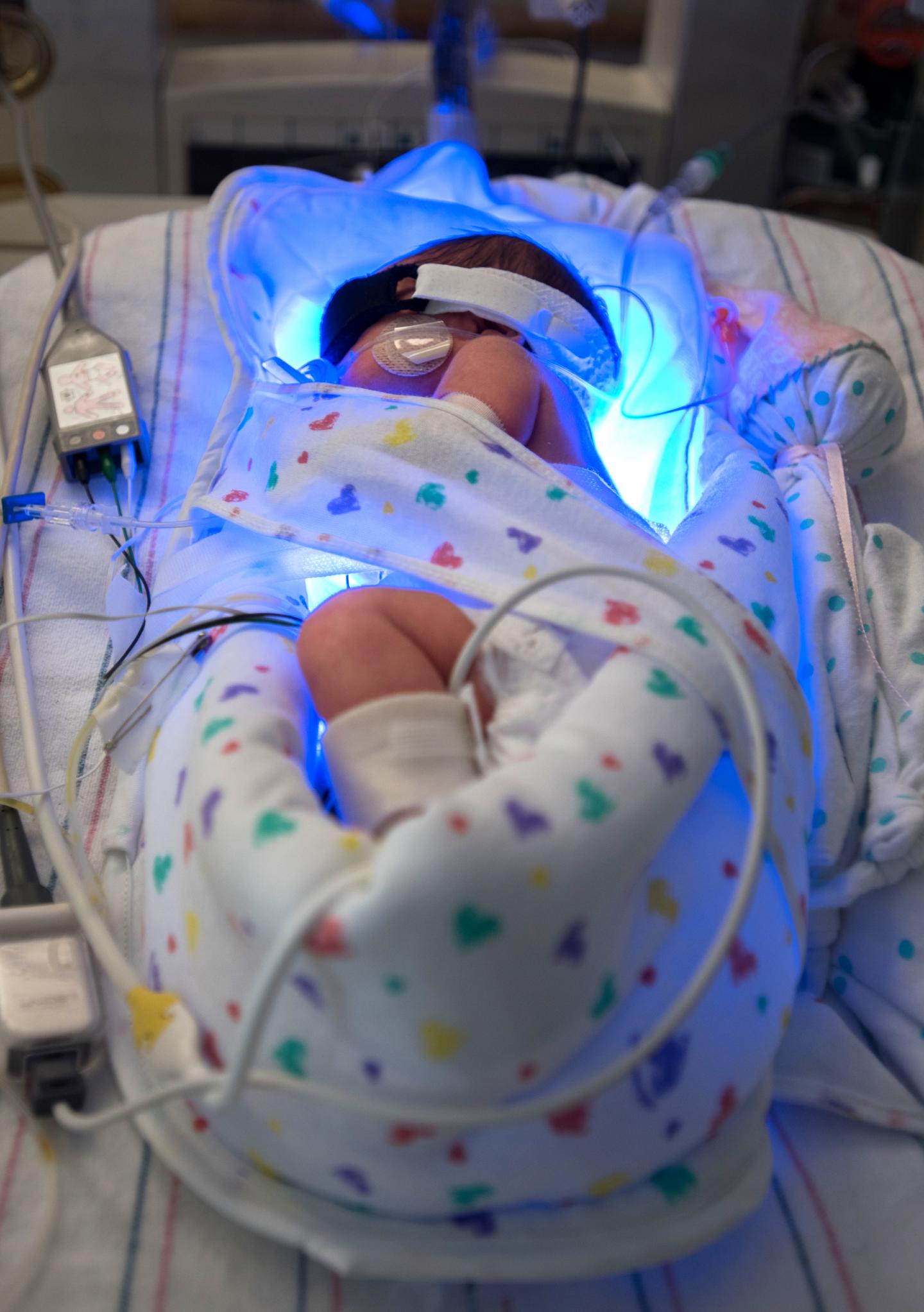 Infant Undergoing Phototherapy (vertical)