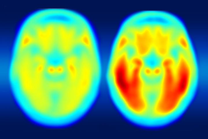 Brain Imaging Links Alzheimer's Decline to Tau Protein