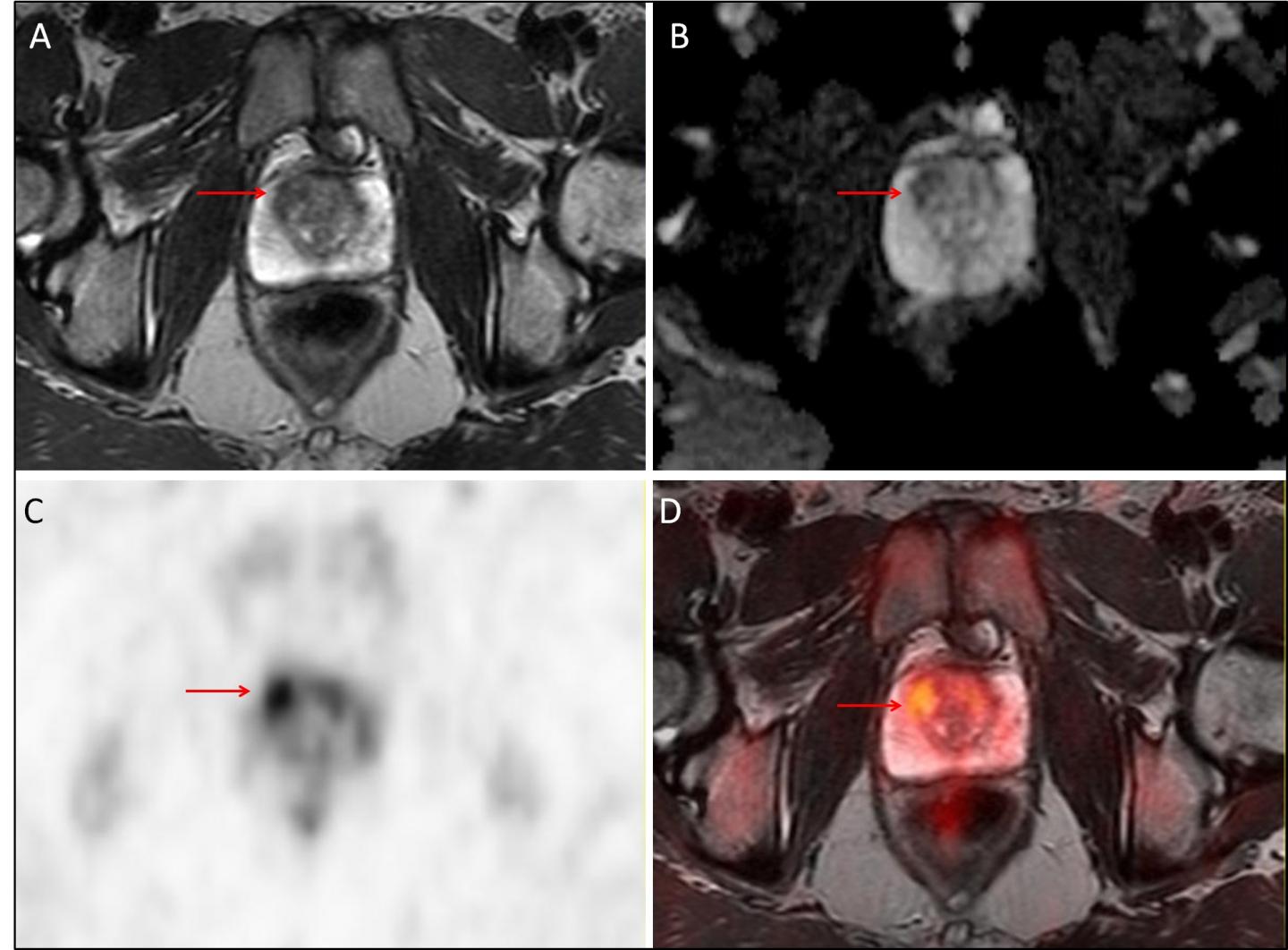 PET/MRI Comparison Images of Prostate Cancer