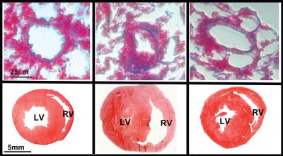 Impact of MicroRNA-193 on Pulmonary Hypertension