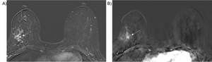 52-year-old woman with stereotactic biopsy-proven intermediate grade DCIS, upgraded to high-grade invasive ducal carcinoma