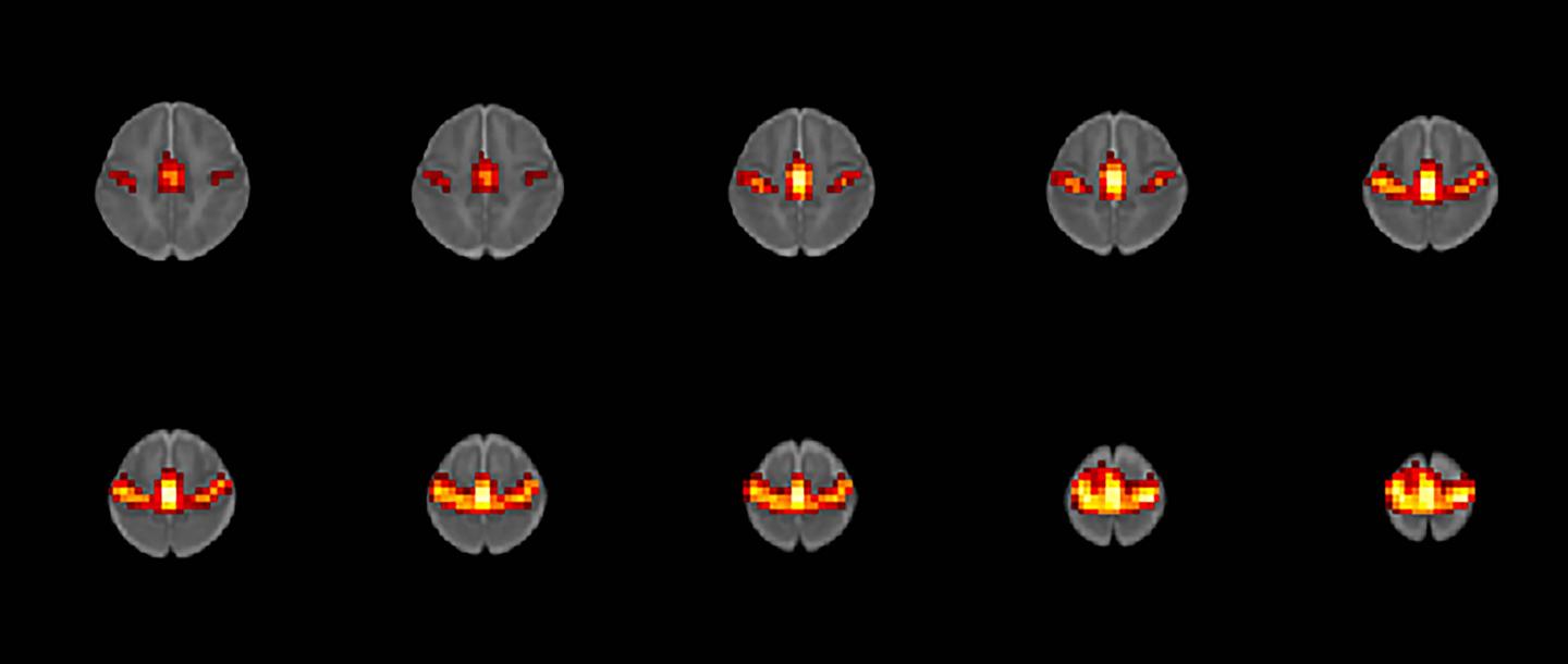 Prenatal Opioid Exposure May Alter Brain Function in Babies