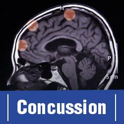 New Open Access Journal: <i>Concussion</i>