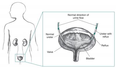 Vesicoureteral Reflux Illustration