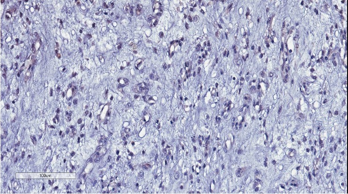 Sarcoma cells