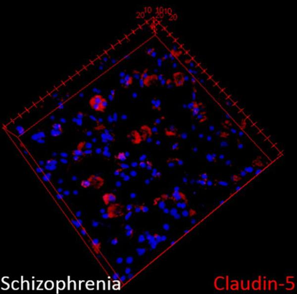 Human Schizophrenia Patient Brain