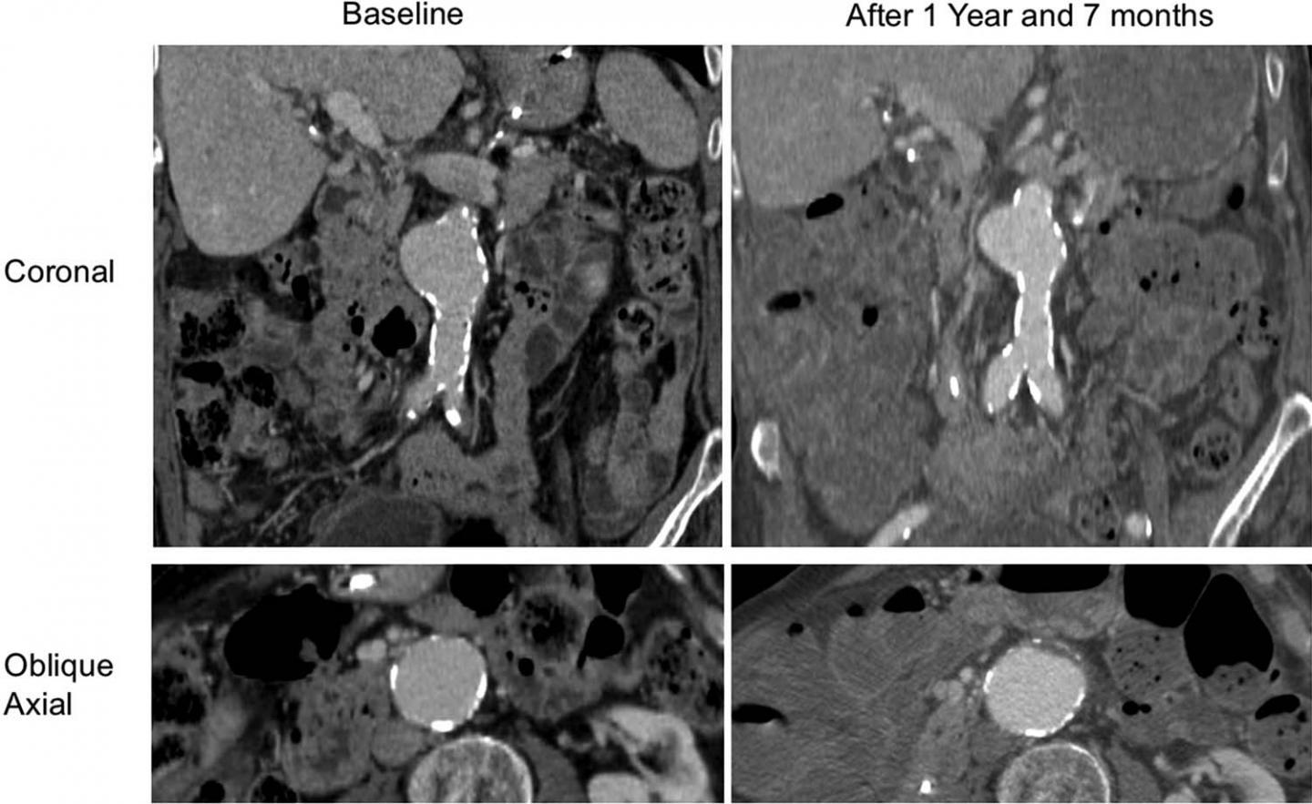 Presence of Blood Clot Associated with Rapid Aortic Aneurysm Growth (2 of 3)