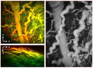 Disease captured by UCL hand-held 3D photoacoustic scanner