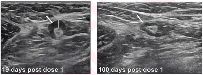 Lymph node measurements in 33-year-old woman for bilateral screening breast ultrasound