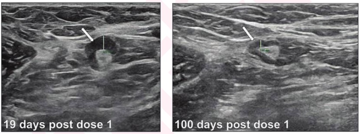 Resolution time of COVID vaccine related lymp EurekAlert