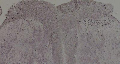 How to Stop Pain from Serious Burns Using Epigenetics