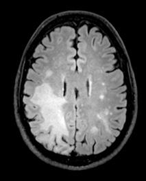 PML Lesions in the Brain