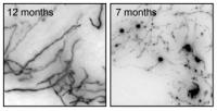 Effect of Alzheimer's Disease on Cholinergic Neurons