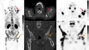 68Ga-PSMA-11 PET/CT of an 82-year-old male patient with bone pain and PSA levels of 960 ng/ml.