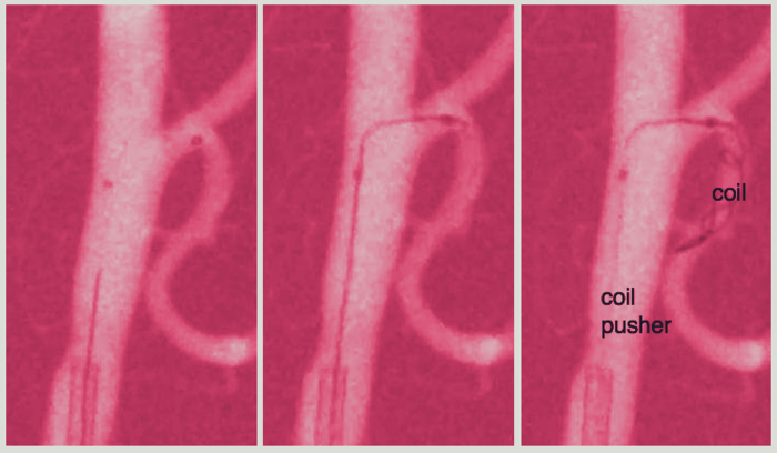 Steerable catheter navigating a brain artery