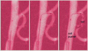 Steerable catheter navigating a brain artery