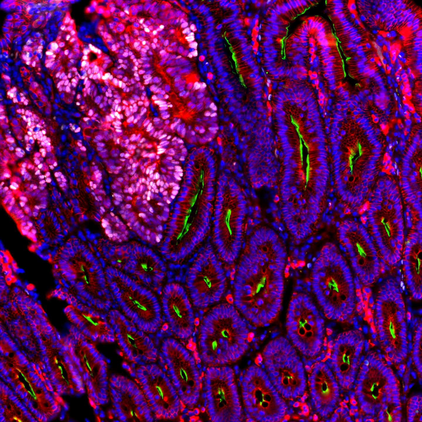 R-Spondin 1 -Treated Intestinal Tumor