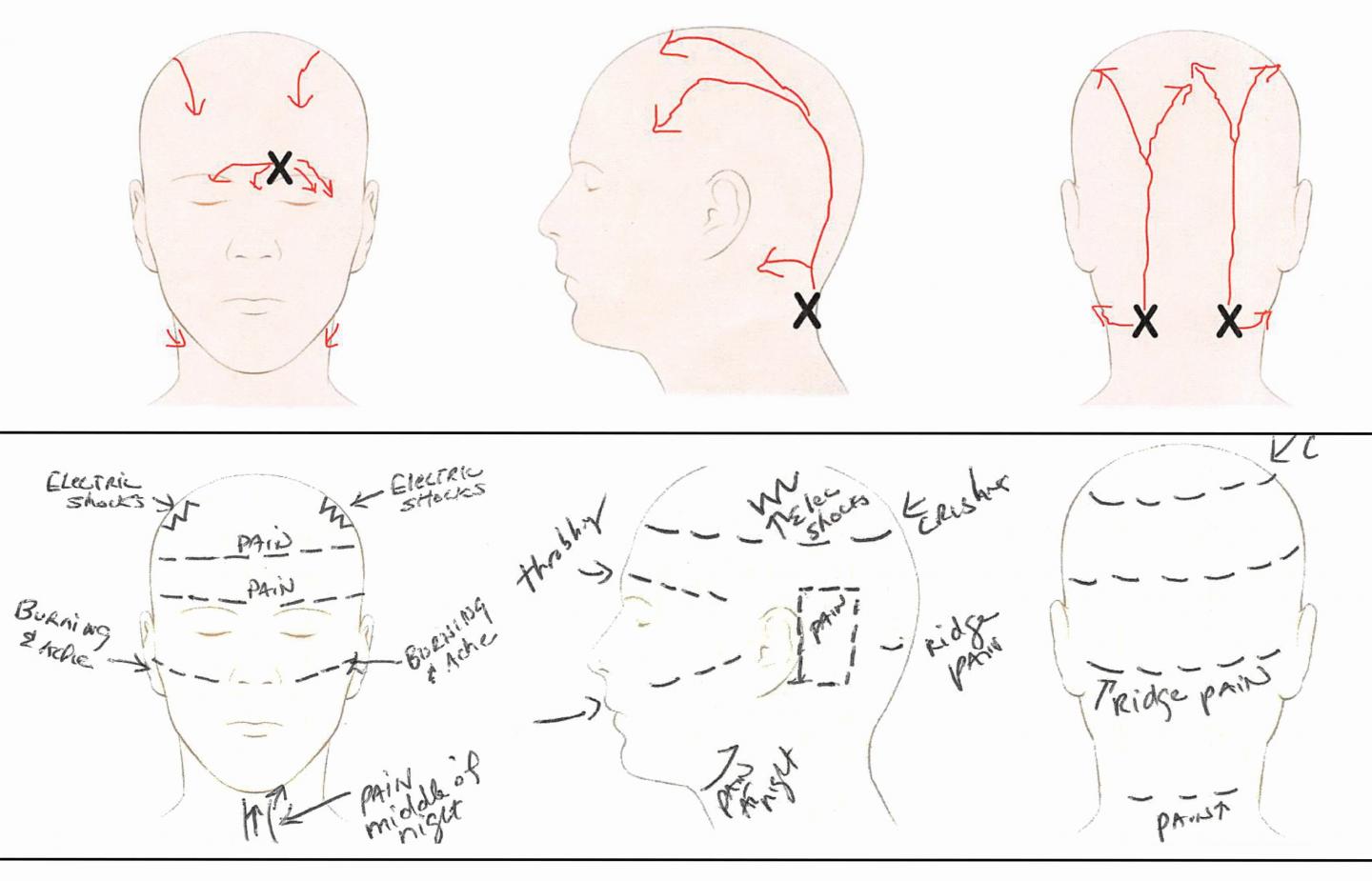 Patient Pain Sketches Can Predict Surgical Outcomes in Trigger-Site Deactivation Surgery for Headaches