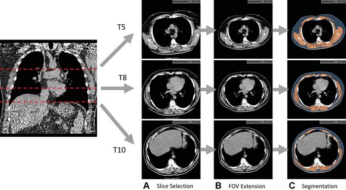 Example of fully automated body composition assessment in the lung cancer screening noncontrast low-dose chest CT scan.