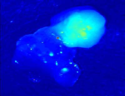 Mysterious Parathyroid Glow