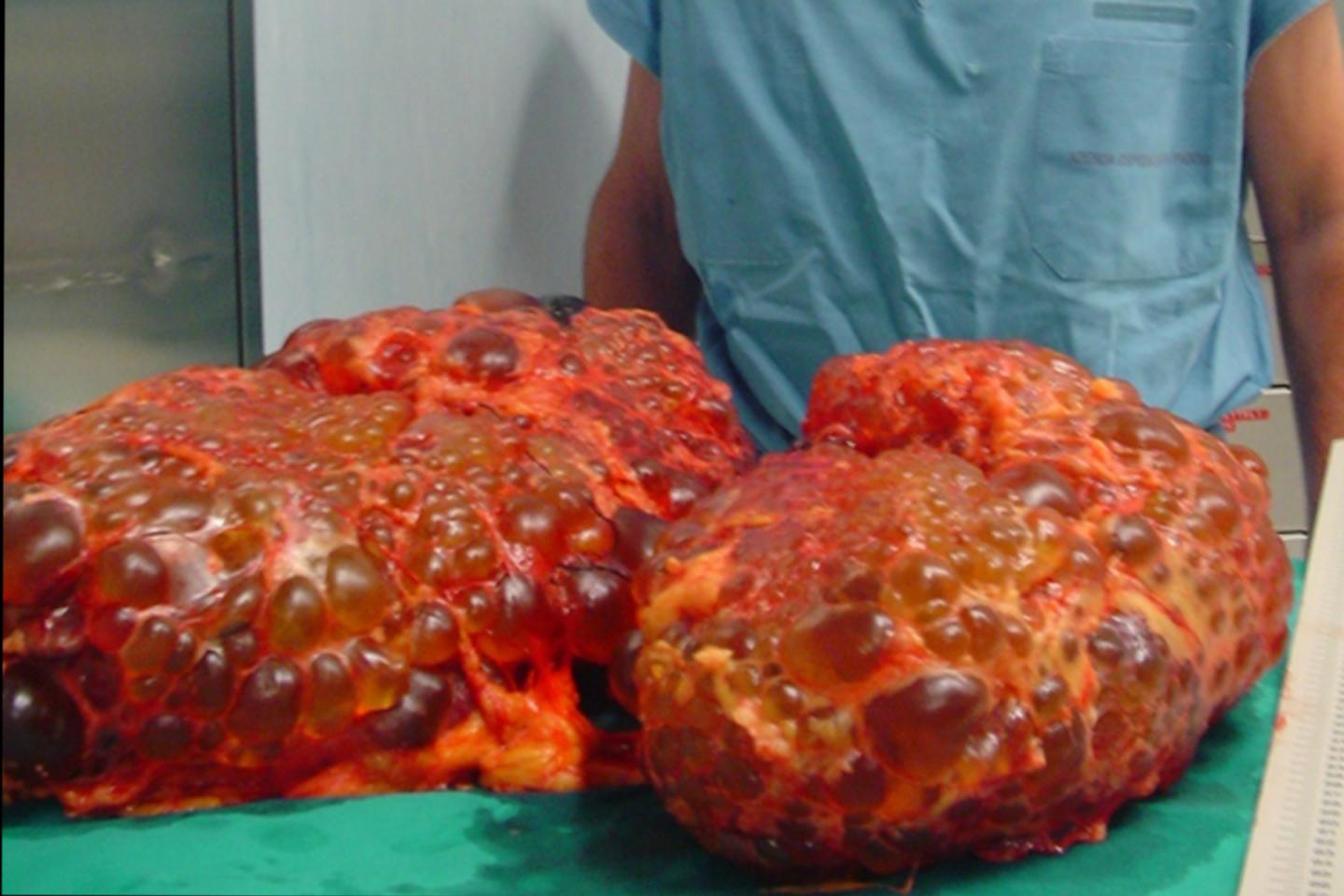 Polycystic Kidney Disease