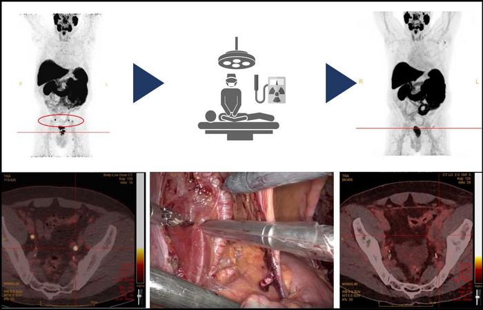 Preoperative and postoperative PSMA-PET/CT images demonstrate the successful removal of two positive pelvic lymph nodes in the radioguided surgical procedure.