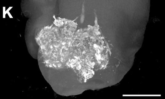 Tumor-Killing Liquid Offers A Safer "Bridge" Therapy for Patients with Liver Cancer (3 of 3)