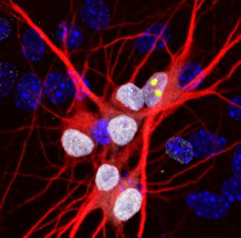 Neurons Created from ALS Patients