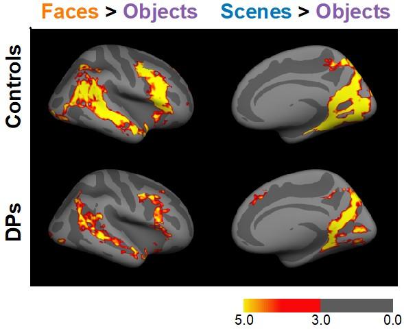 The Yellow and Red Areas Show Right Hemisphere Brain Regions That Prefer Looking at Faces