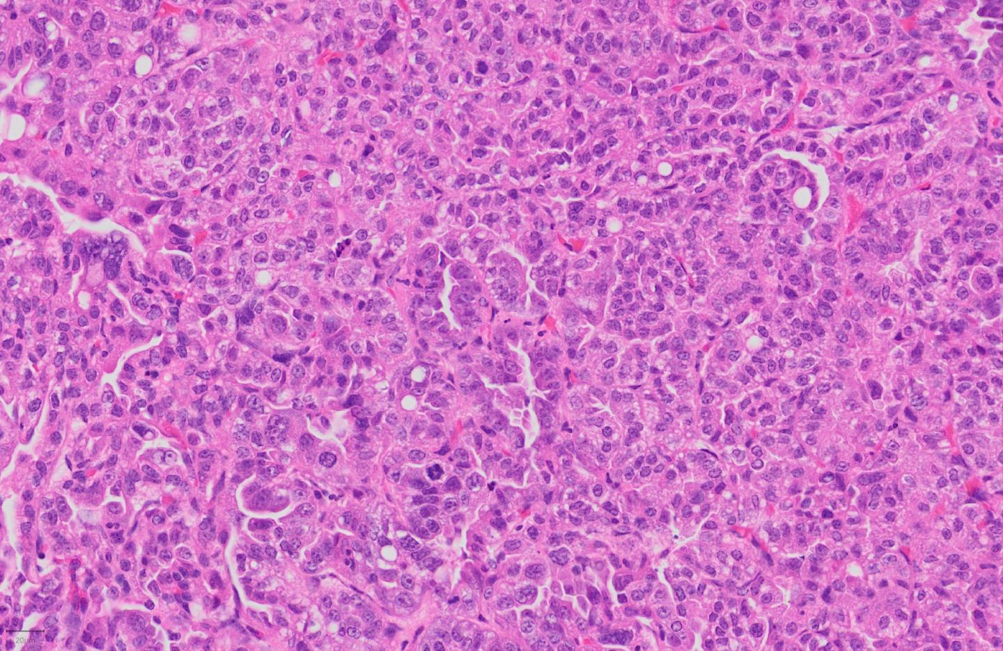 Histological staining of a lung adenocarcinoma