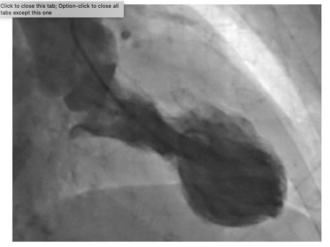 Stressed brain linked to broken heart