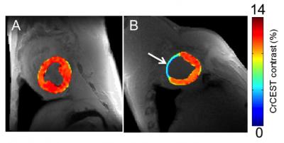 Tweaking MRI to Track Creatine May Spot Heart Problems Earlier