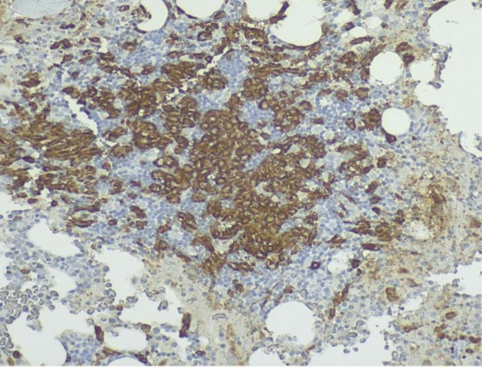 Breaking point: Systemic mastocytosis manifesting as severe osteoporosis