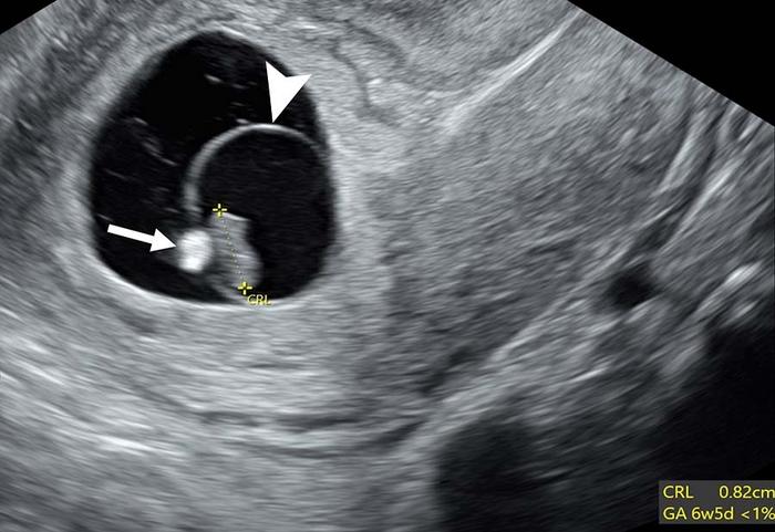 Poor prognosticators: calcified yolk sac and expanded amnion sign