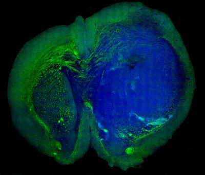 Brain Tumor Visible in SRS Microscropy