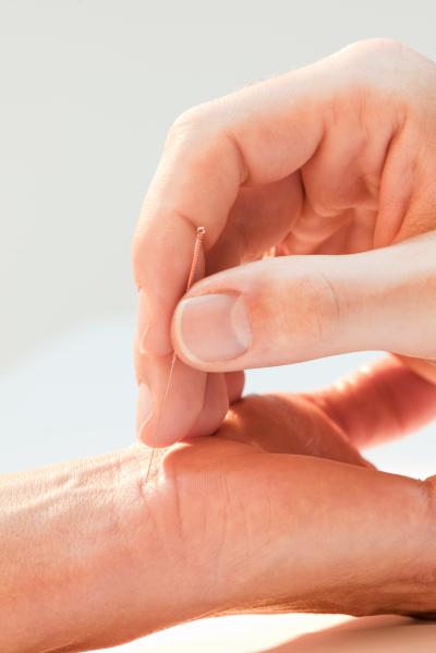 Acupuncture
