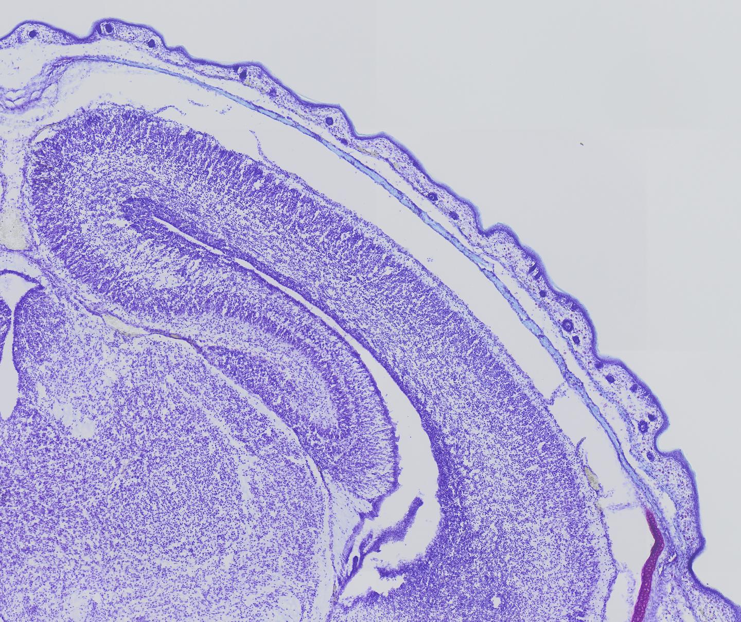 Malformations of the cortex